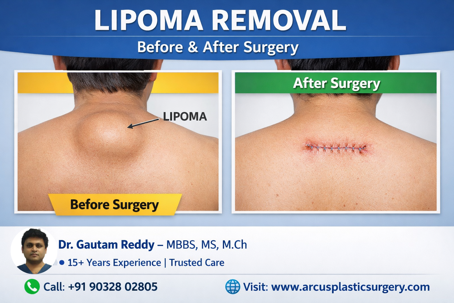 Best Hospital for lipoma Removal in Hyderabad