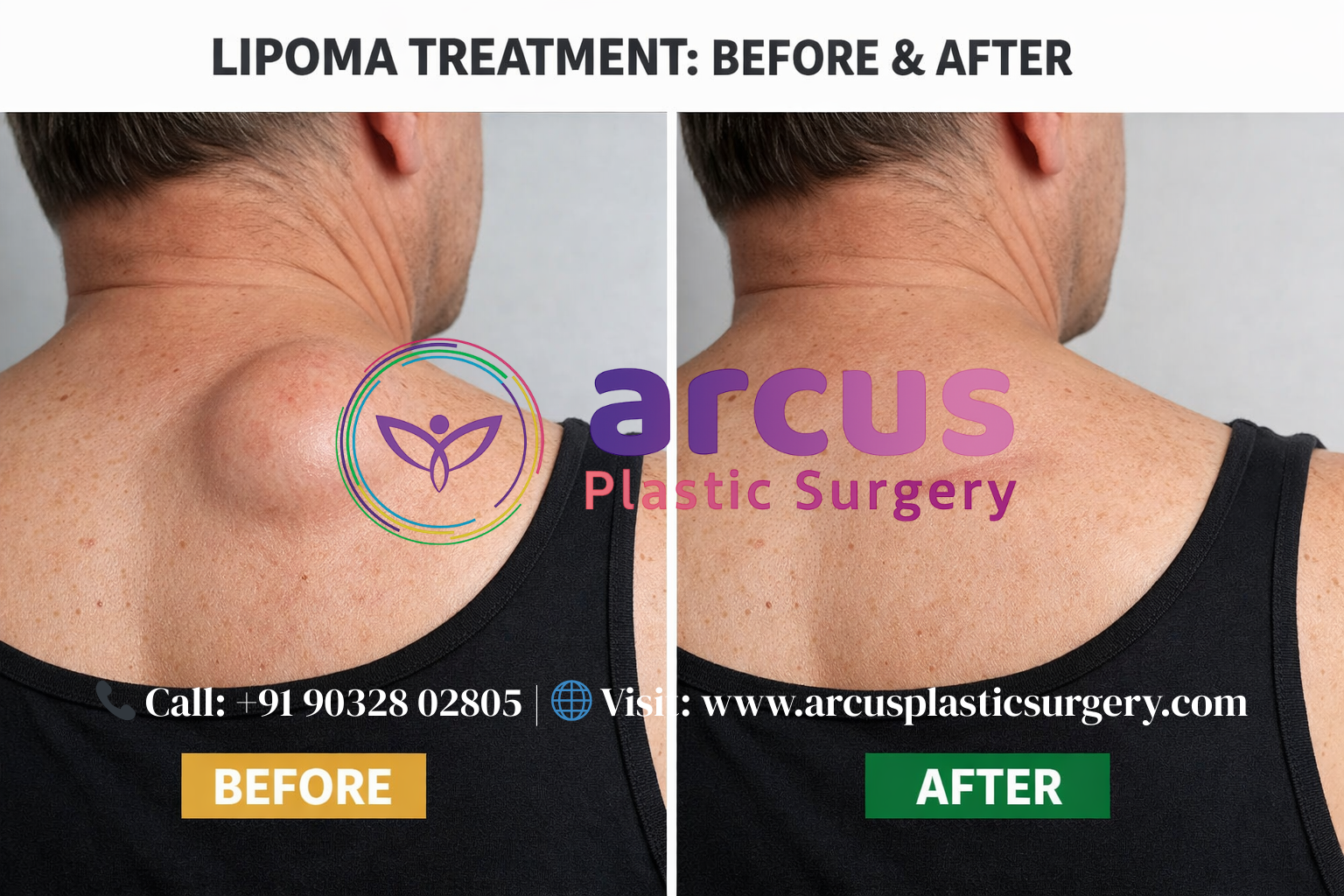 Top Clinic For Lipoma Treatment in Hyderabad