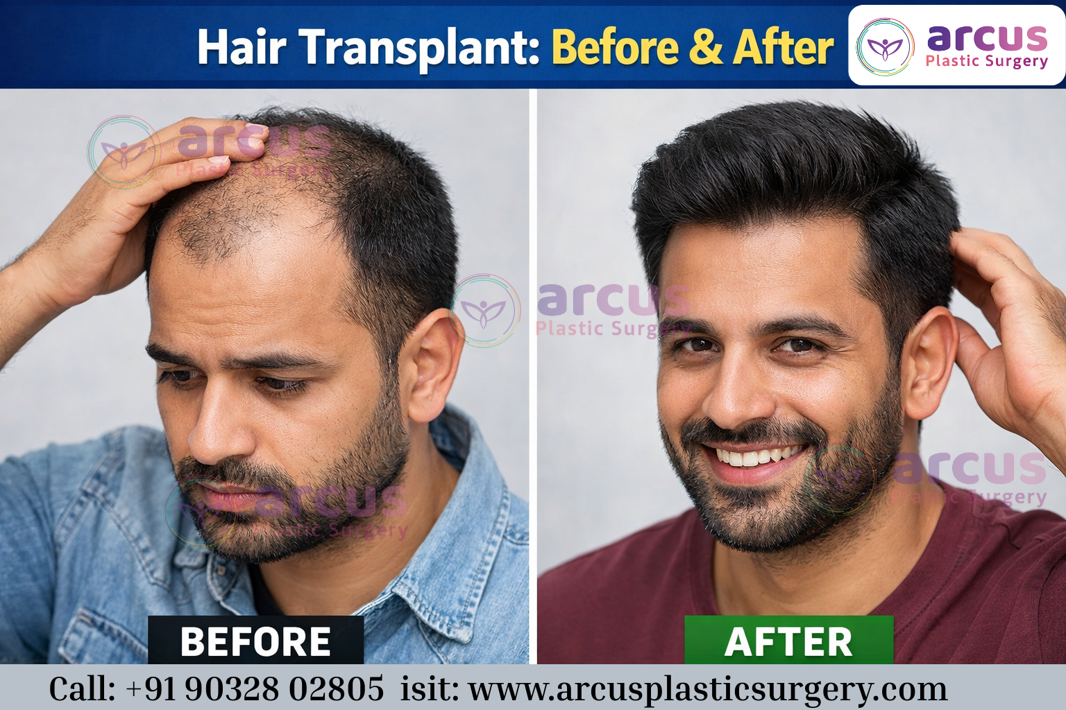 Best Hair Transplant Treatment in KPHB