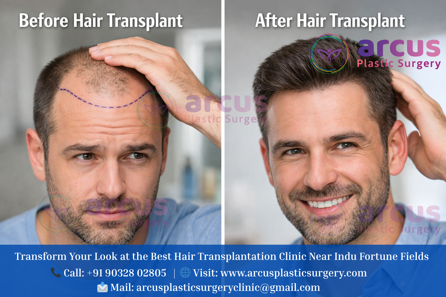 Best Hair Transplantation Clinic Near Indu Fortune Fields