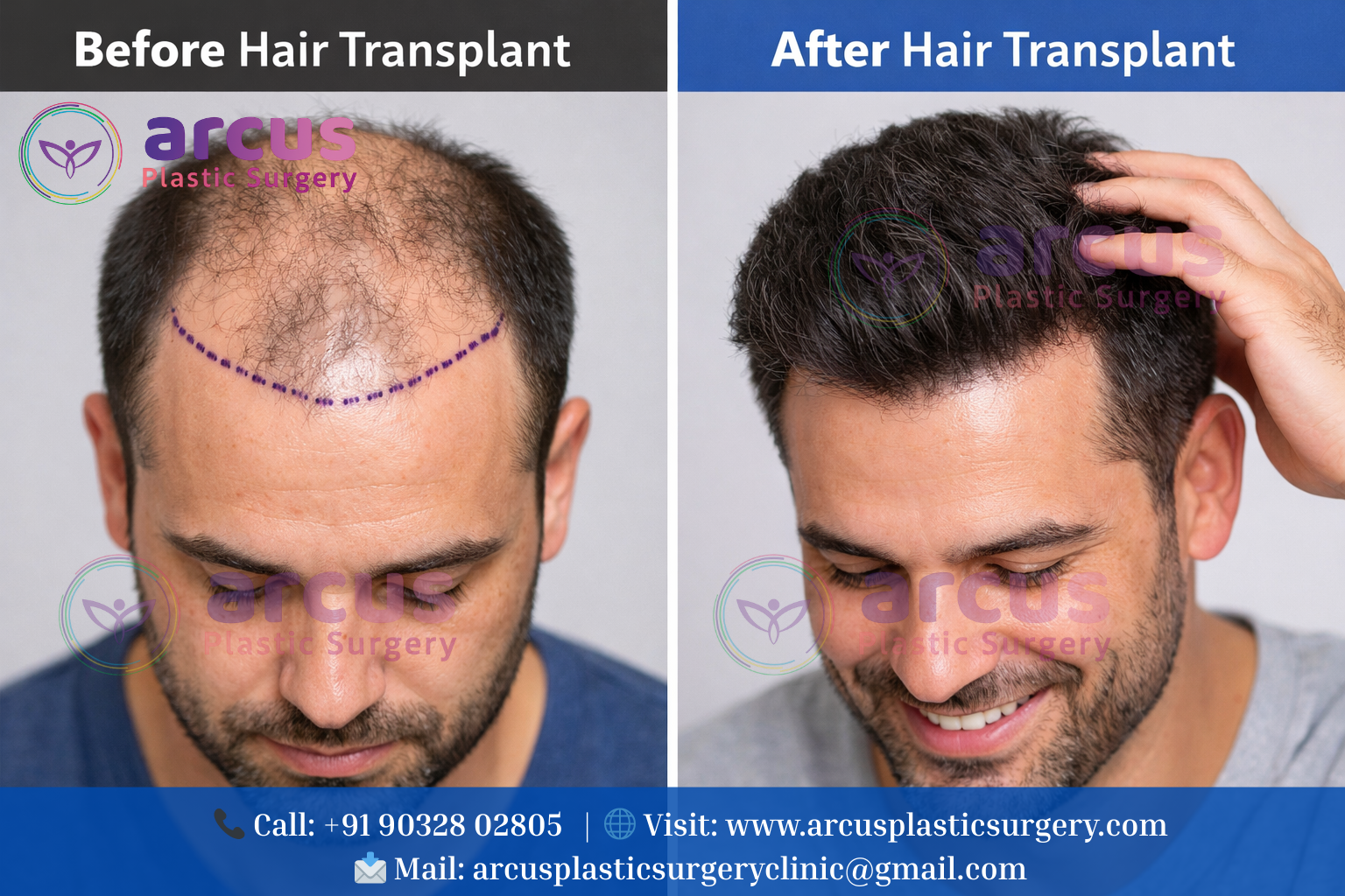 Best Hair Transplant Center Near Indis Onecity