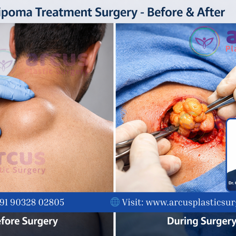 Lipoma Treatment Hospital in Hyderabad